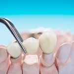 Your Road To Oral Wellness: Benefits Of Dental Bridges 
