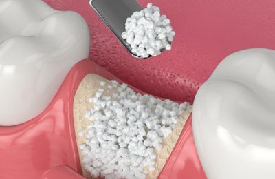 Nurturing Your Recovery: The Crucial Role of Proper Healing After Bone Grafting in Knoxville, TN