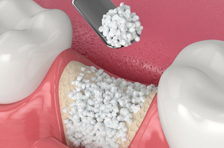 Nurturing Your Recovery: The Crucial Role of Proper Healing After Bone Grafting in Knoxville, TN