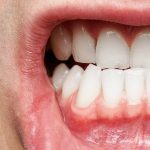 Top Risks For Your Gums 