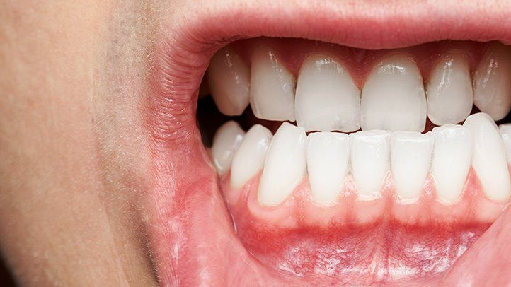 Top Risks For Your Gums 